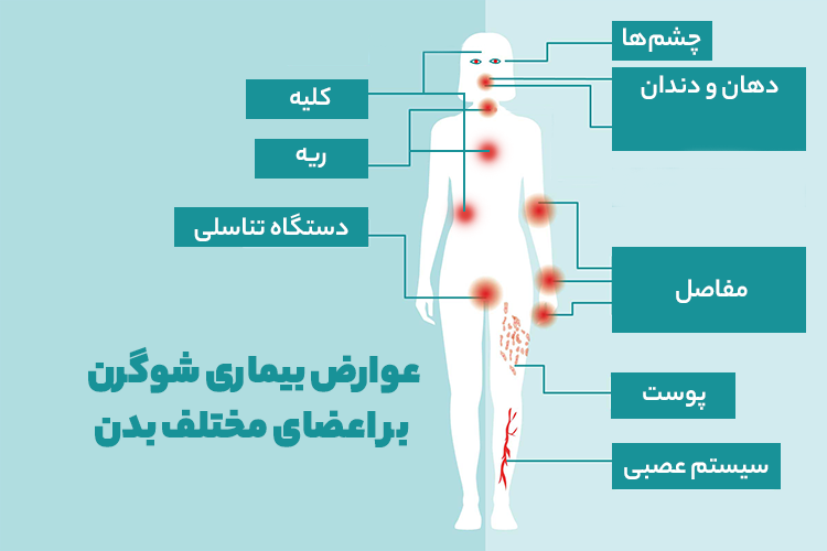 عوارض بیماری شوگرن بر اعضای مختلف بدن
